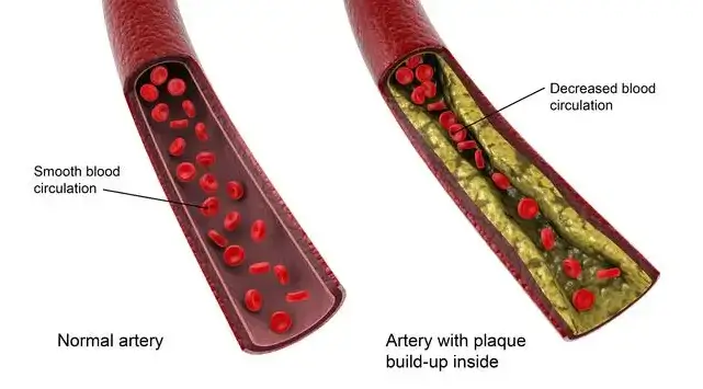 Recommended nattokinase dosage for arteries health